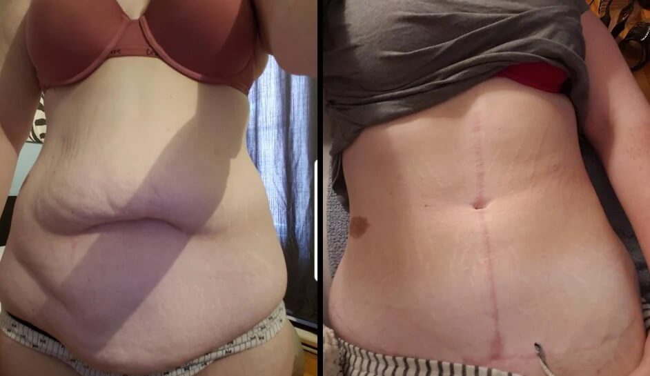 Fleur De Lis Tummy Tuck Before and After