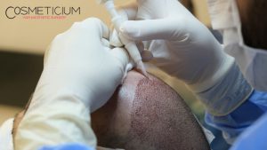 Hair Transplant in Turkey