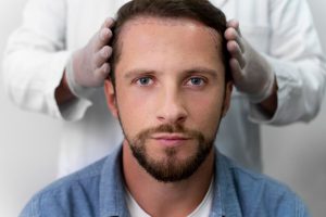 Hairline before Hair Transplant