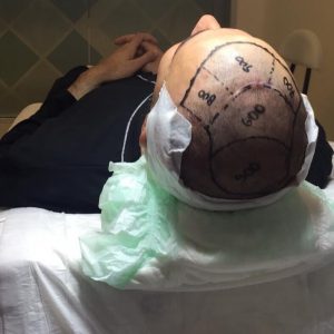 How Many Hair Grafts Do I Need for Hair Transplant?