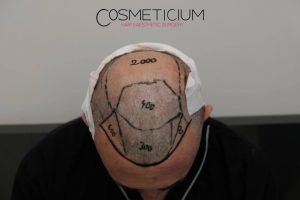 How Many Hair Grafts Do I Need for Hair Transplant?