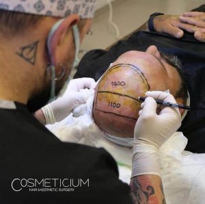 How Many Hair Grafts Do I Need for Hair Transplant?