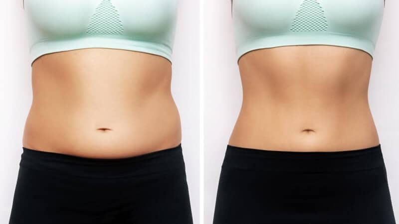 Get Rid of Fluid Pockets after Liposuction