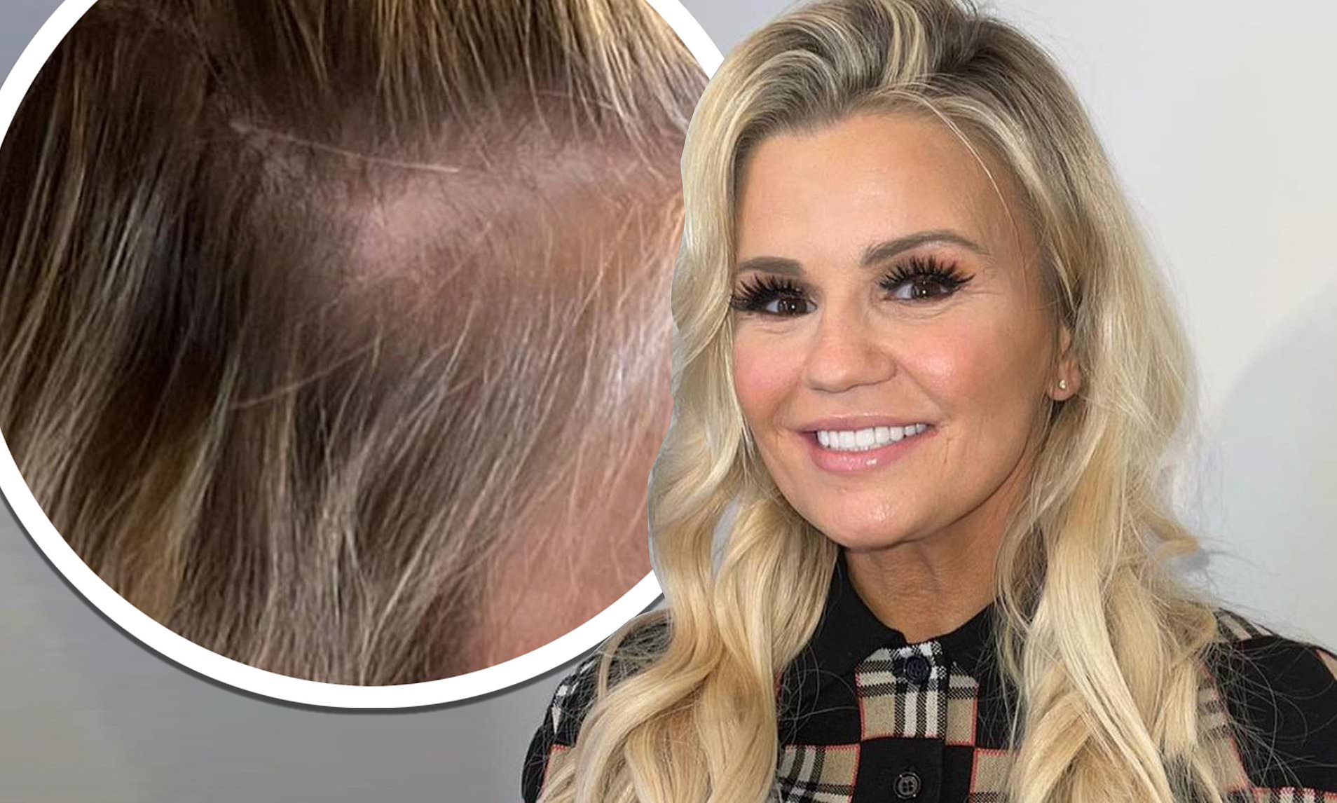 Kerry Katona hair loss