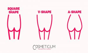 BBL Hourglass Shape