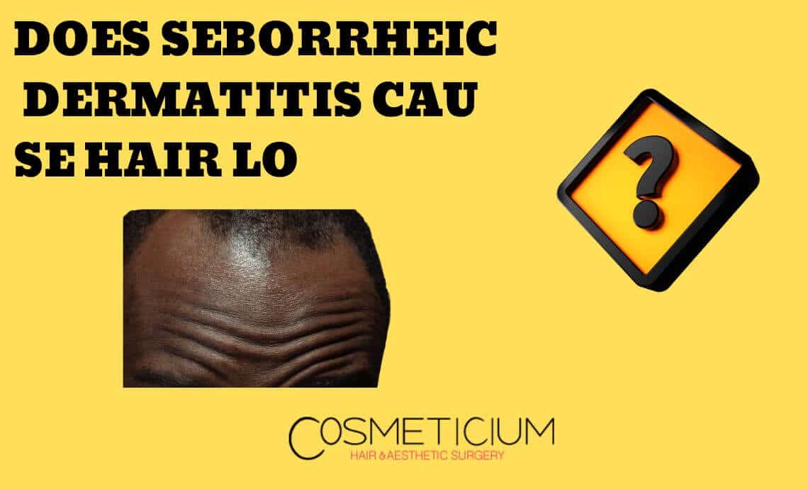 Does Seborrheic Dermatitis Cause Hair Loss? Find Out Today!