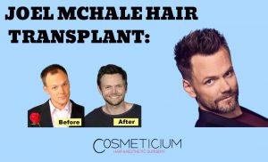 Joel McHale Hair Transplant