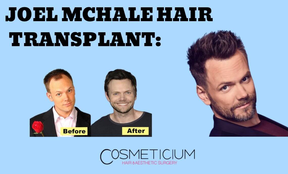 Joel McHale Hair Transplant: From Disaster to Miracle