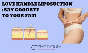 What is Flank Liposuction?