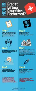 How-Is-Breast-Lifting-Operation-Performed-410x1024