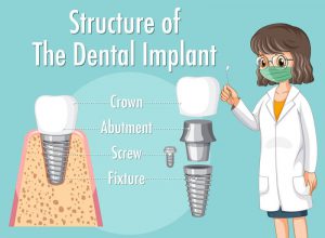 What Are Dental Implants Made Of?