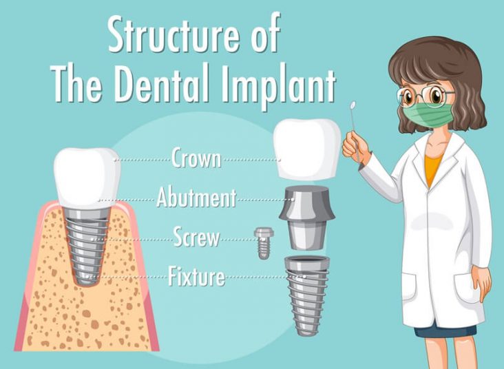 What Are Dental Implants Made Of? Learn These 5 Materials!