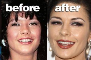 Catherine Zeta-Jones Veneers
