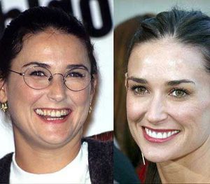 Demi Moore Porcelain Veneers