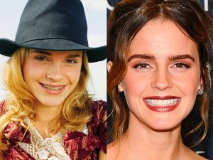 Emma Watson Veneers