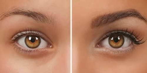 Eyebrow Transplantation