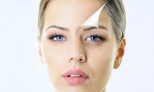 facelift (1)