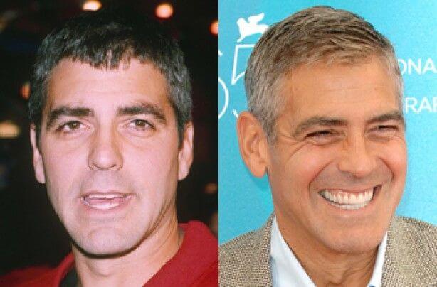George Clooney Veneers