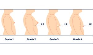 Gynecomastia