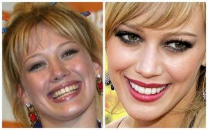 Hilary Duff Porcelain Veneers