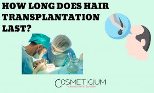 How Does Hair Transplantation Last A Lifetime?