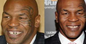 Mike Tyson Veneers