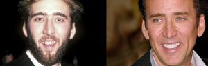 Nicolas Cage Porcelain Veneers