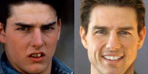 Tom Cruise Veneers