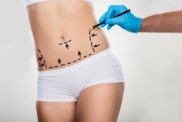 tummy tuck cosmeticium
