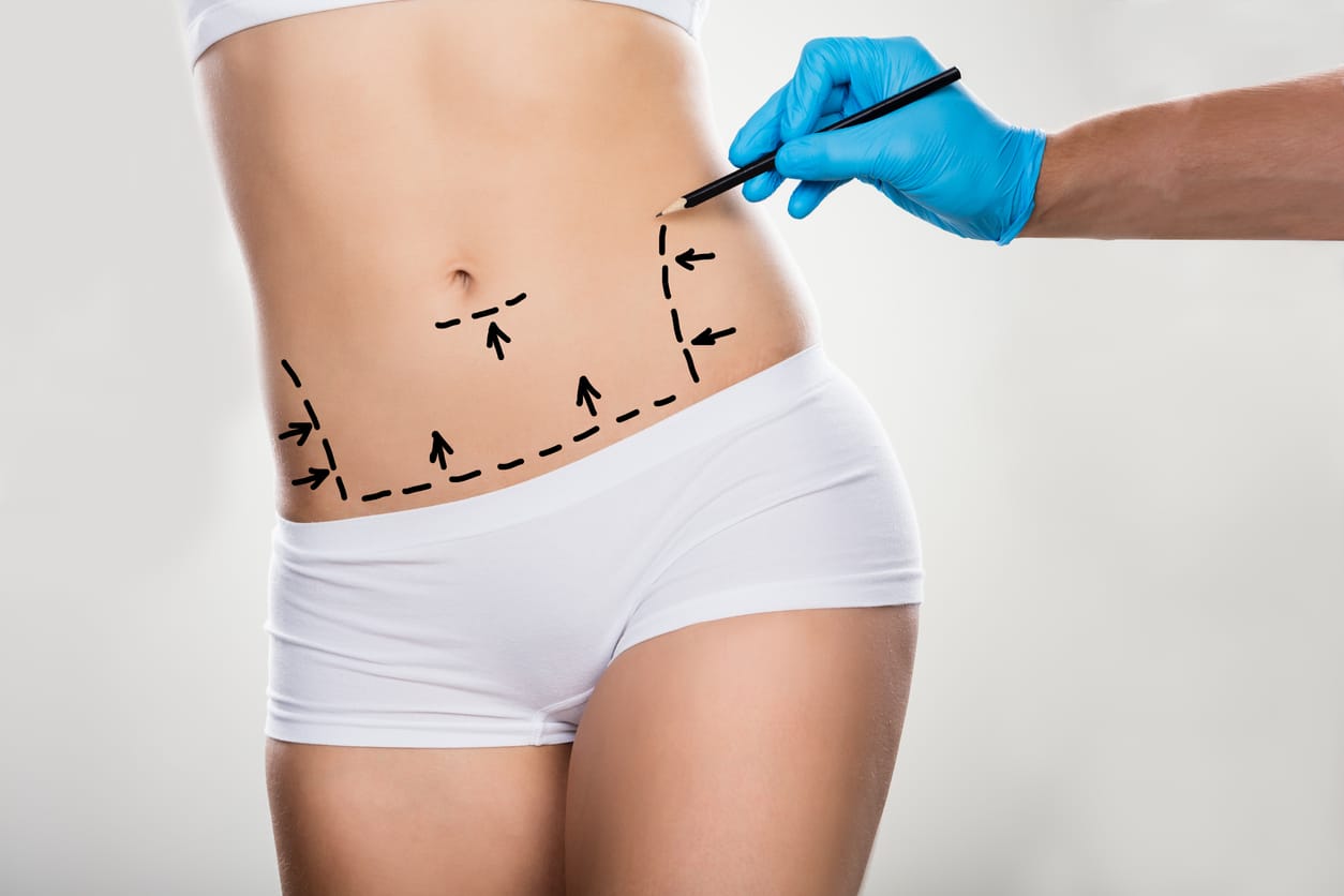 Tattoos can change after liposuction or Tummy tuck