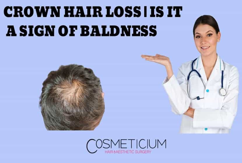 Crown Hair Loss | Is It a Sign Of Baldness?