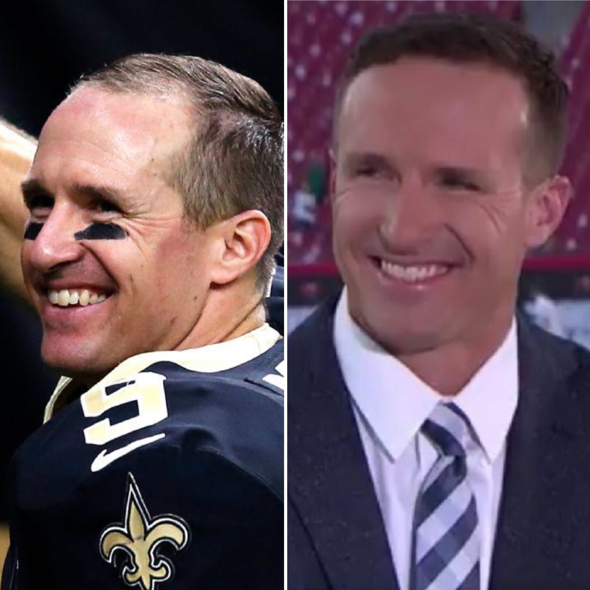 Drew Brees Hair Transplant Before & After