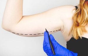 Arm Liposuction Cost