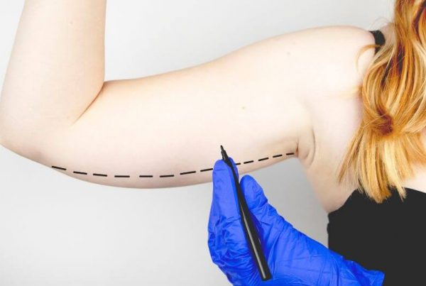 Arm Liposuction Cost