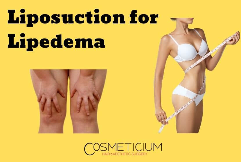 Liposuction for Lipedema | Possible to Recover from Lipedema