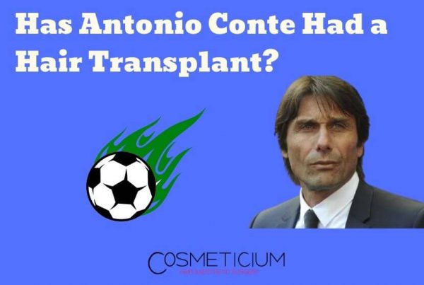 Antonio Conte Hair Transplant