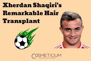 Xherdan Shaqiri Hair Transplant