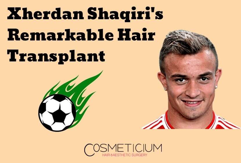 Xherdan Shaqiri’s Remarkable Hair Transplant