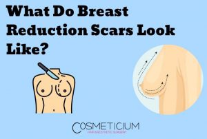 What Do Breast Reduction Scars Look Like?