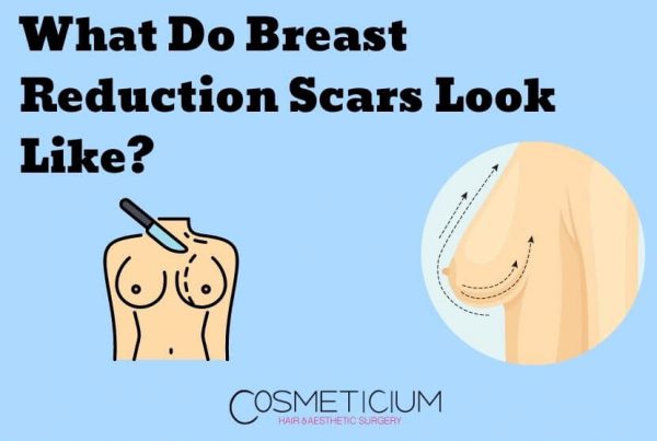 What Do Breast Reduction Scars Look Like?