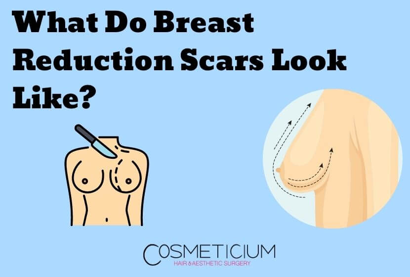 What Do Breast Reduction Scars Look Like? (Recovery Timeline)