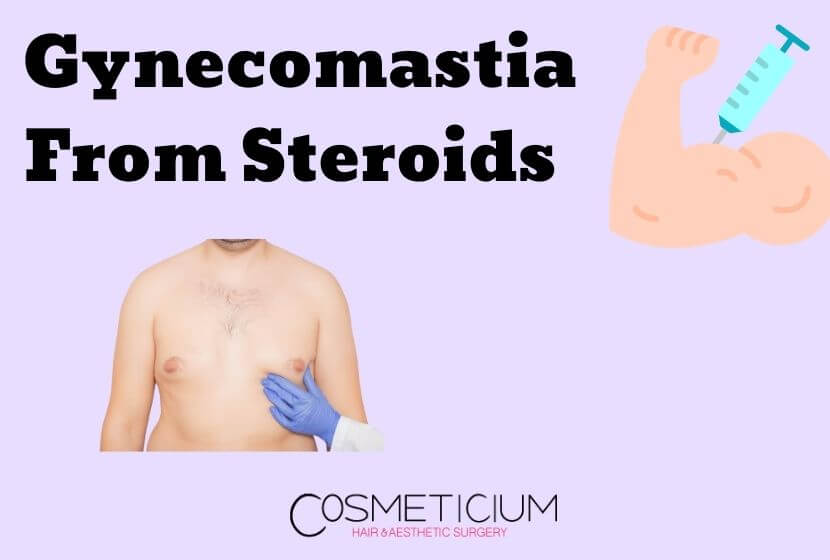 What You Should Know About Gynecomastia From Steroids?