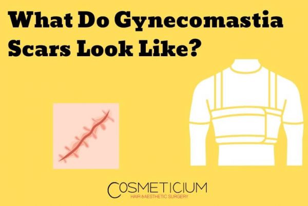 Gynecomastia Scars Look Like