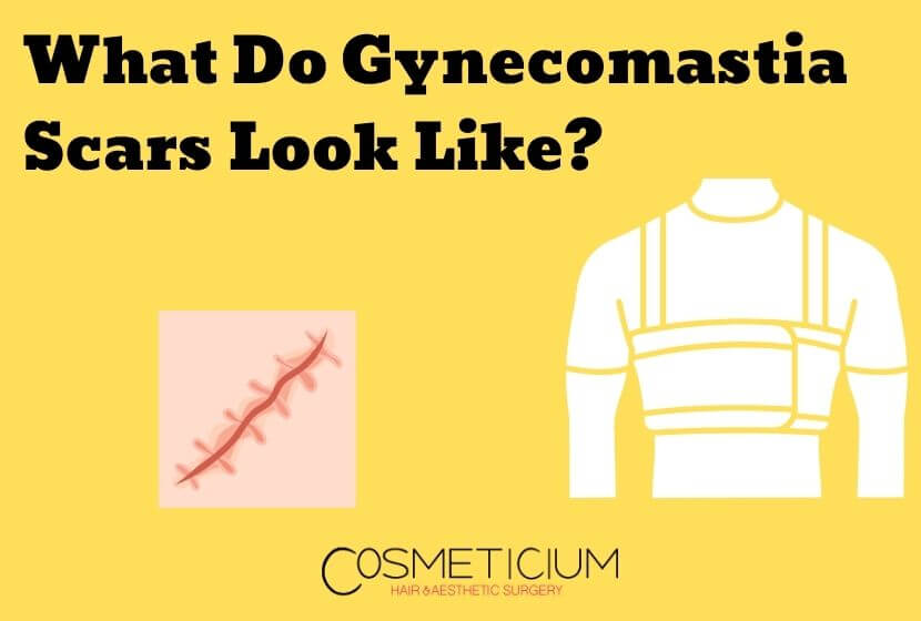 What Do Gynecomastia Scars Look Like? How Bad Are They?