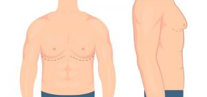 Gynecomastia Before & After