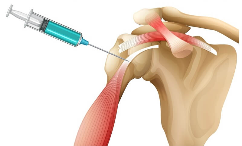 Steroids Risk of Gynecomastia