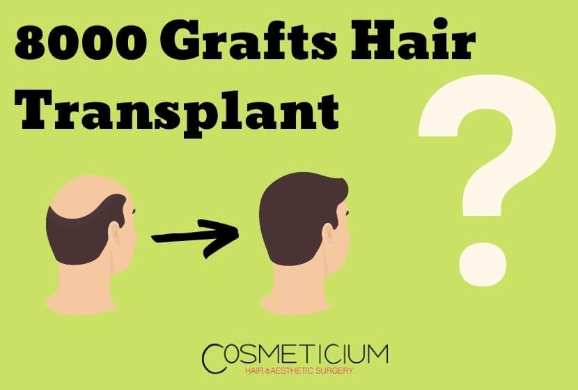 Is 8000 Grafts Hair Transplant Enough for Full Hair Coverage?