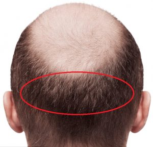 donor area hair