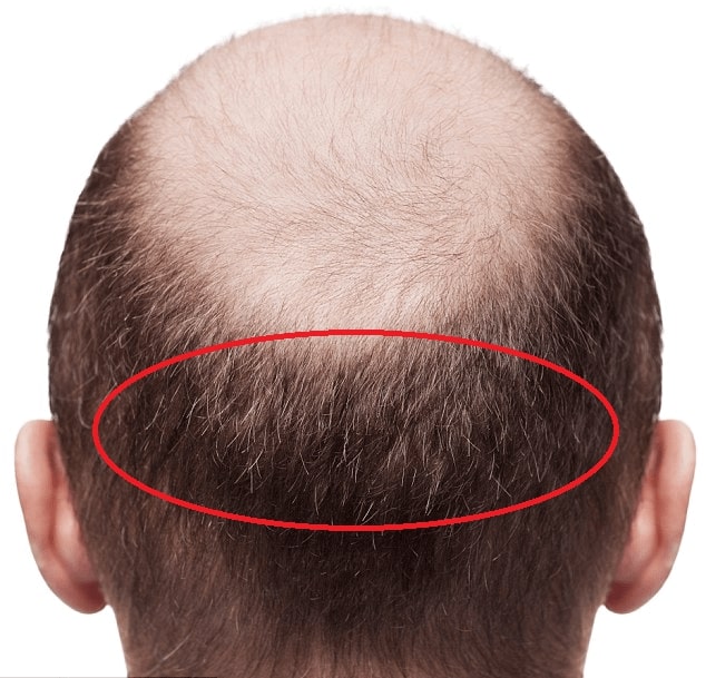 Can The Donor Area Of Chest And Beard Be Used For Hair Transplantation? -  Cosmeticium