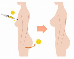 Fat-Transfer-Breast-Augmentation-1-768x614